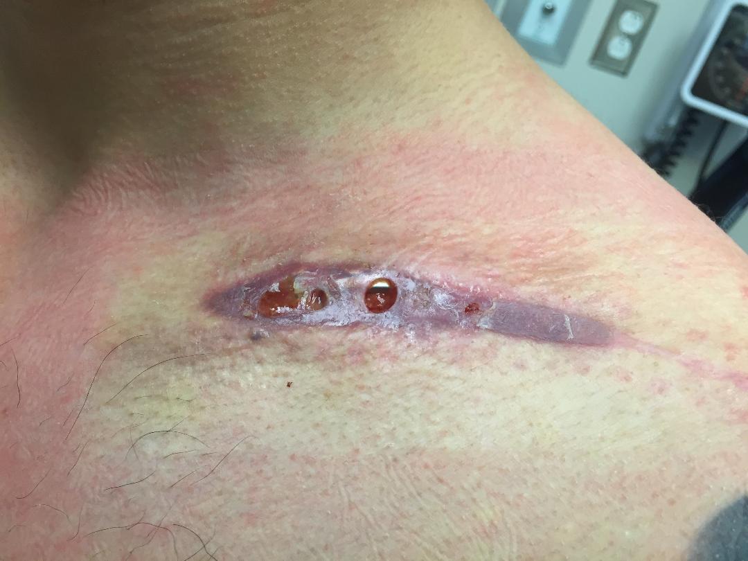Clavicle plate infection